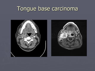Tongue base carcinoma 