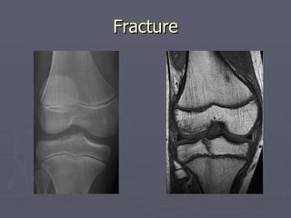 Fracture 