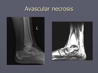 Avascular necrosis 