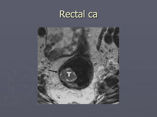 Rectal ca 