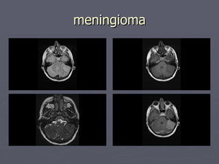meningioma 