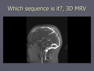 Which sequence is it?, 3D MRV 