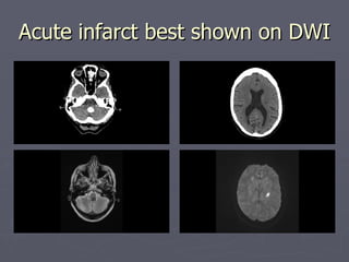 Acute infarct best shown on DWI 