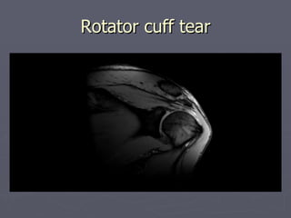 Rotator cuff tear 