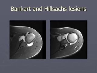 Bankart and Hillsachs lesions 
