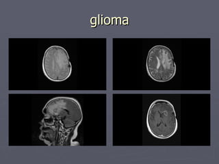 glioma 