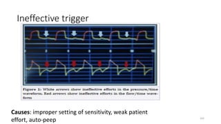 Ineffective trigger
Causes: improper setting of sensitivity, weak patient
effort, auto-peep 103
 