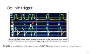 Double trigger
Causes: unusually high ventilatory demand, low PaO2/FiO2, longer/too short inspiratory time of patient
105
 
