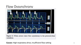 Flow Dysynchrony
Causes: High respiratory drive, insufficient flow setting 106
 