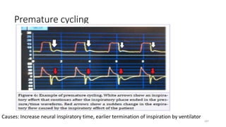 Premature cycling
Causes: Increase neural inspiratory time, earlier termination of inspiration by ventilator
107
 