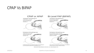CPAP Vs BiPAP
5/28/2021 Dadeldhura Hospital Dadeldhura 55
 