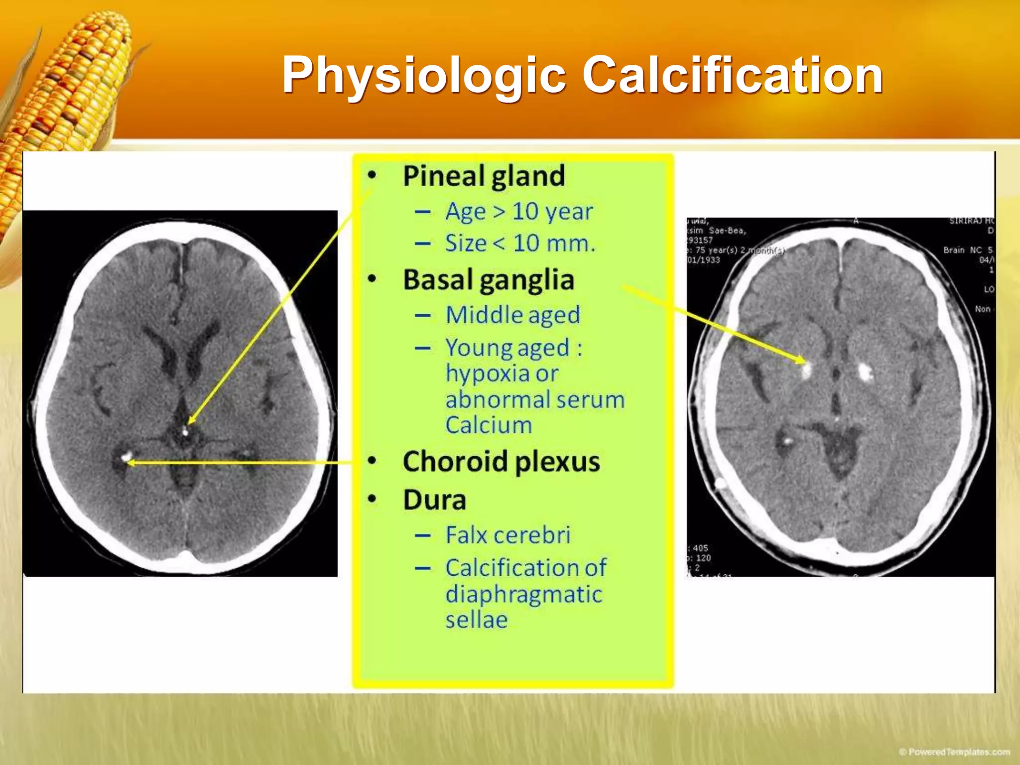 Physiologic Calcification
 