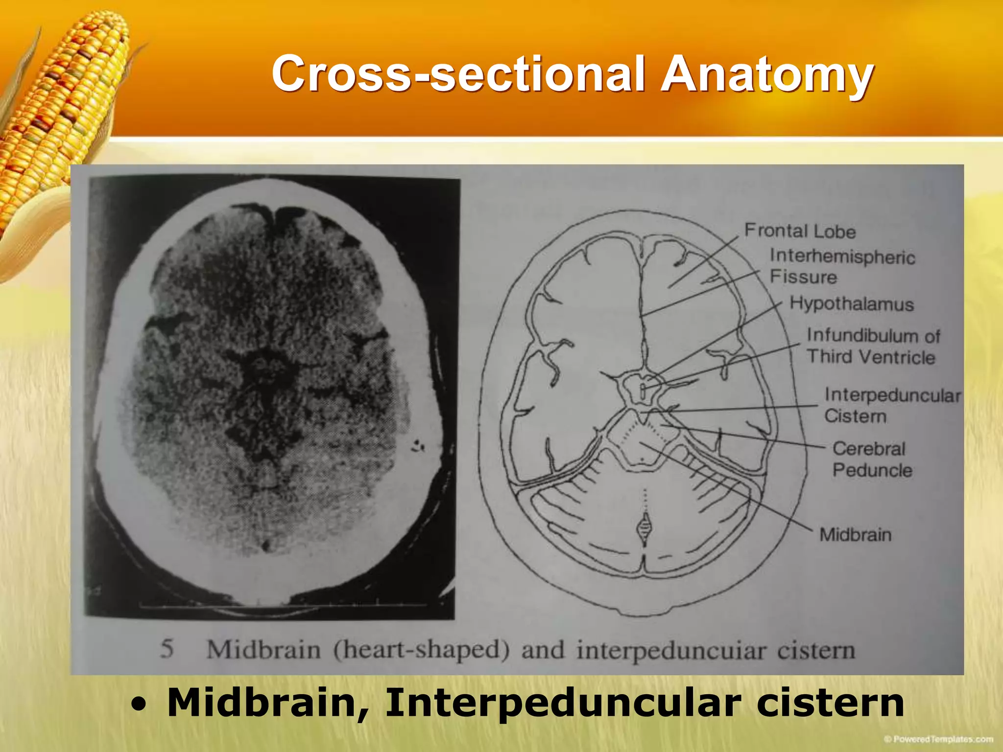Cross-sectional Anatomy
• Midbrain, Interpeduncular cistern
 