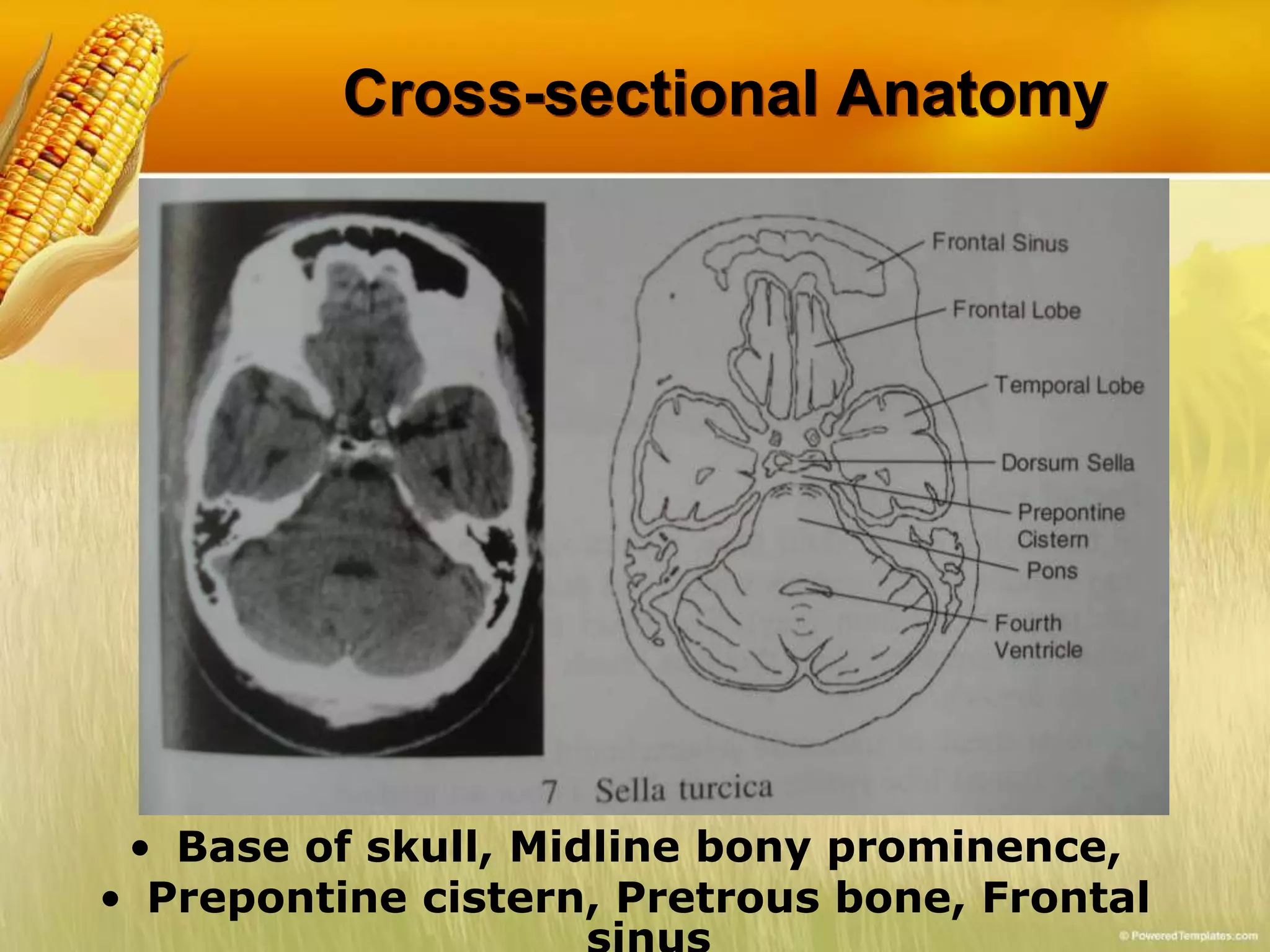 Cross-sectional Anatomy
• Base of skull, Midline bony prominence,
• Prepontine cistern, Pretrous bone, Frontal
 