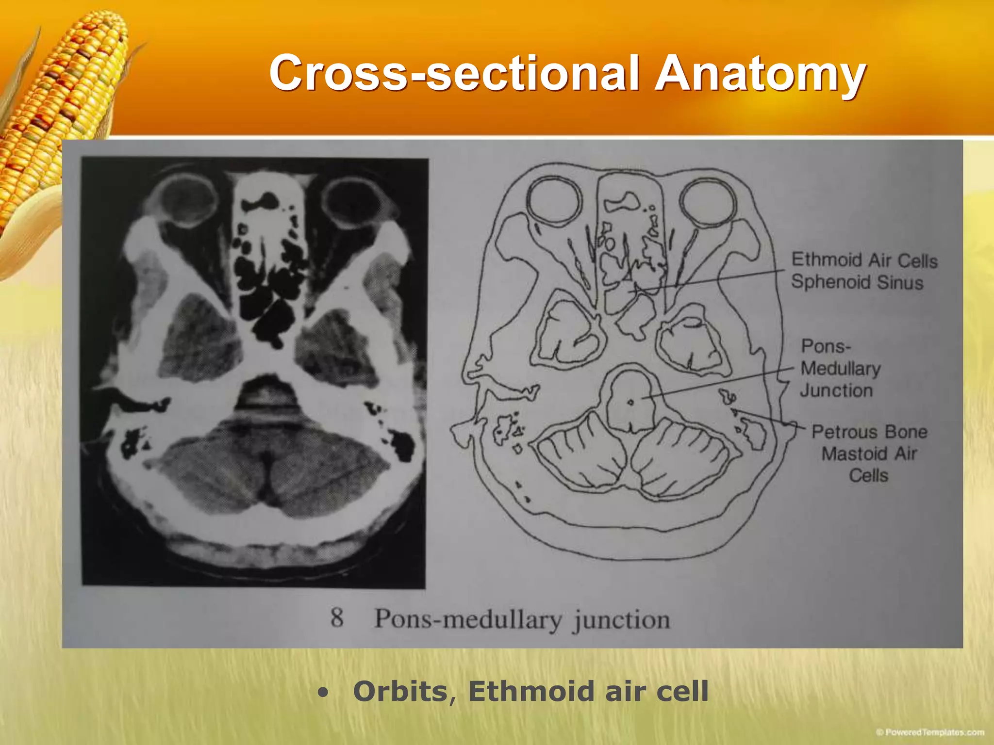Cross-sectional Anatomy
• Orbits, Ethmoid air cell
 