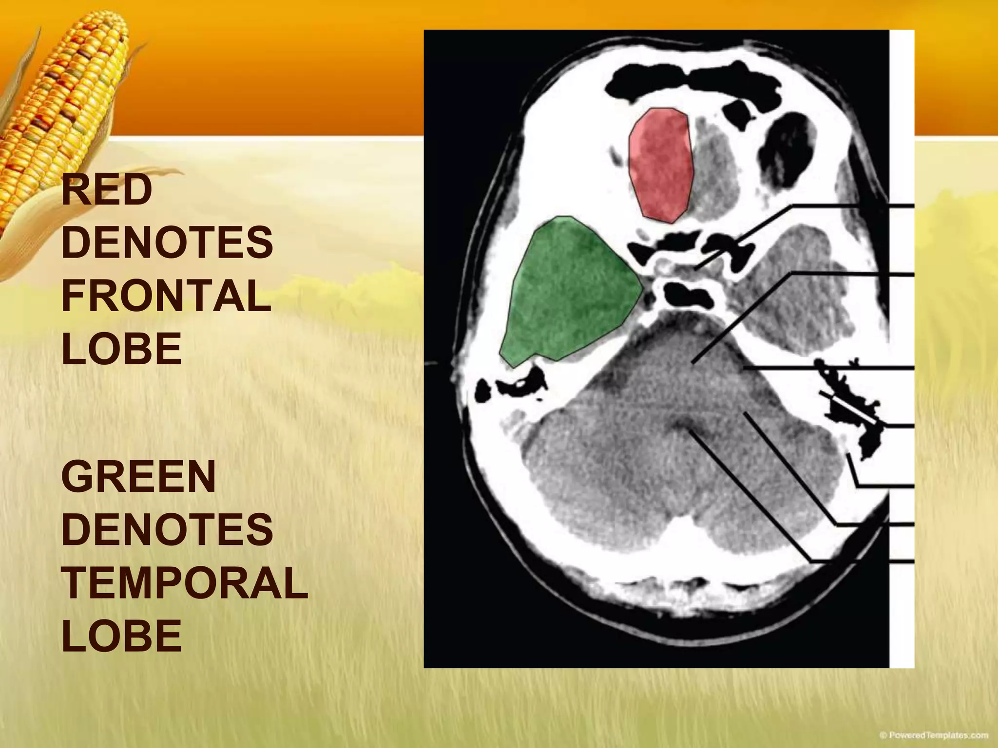 RED
DENOTES
FRONTAL
LOBE
GREEN
DENOTES
TEMPORAL
LOBE
 