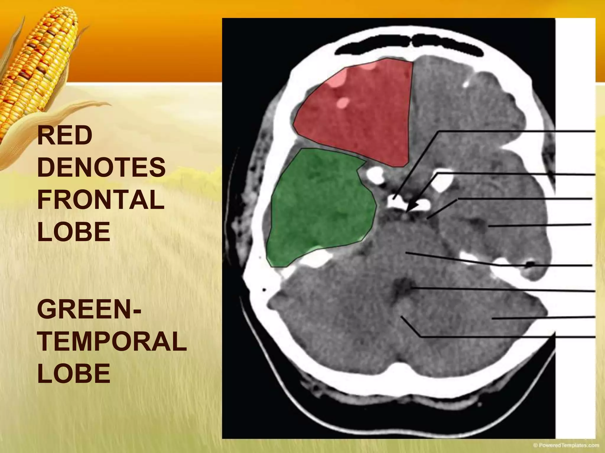 RED
DENOTES
FRONTAL
LOBE
GREEN-
TEMPORAL
LOBE
 
