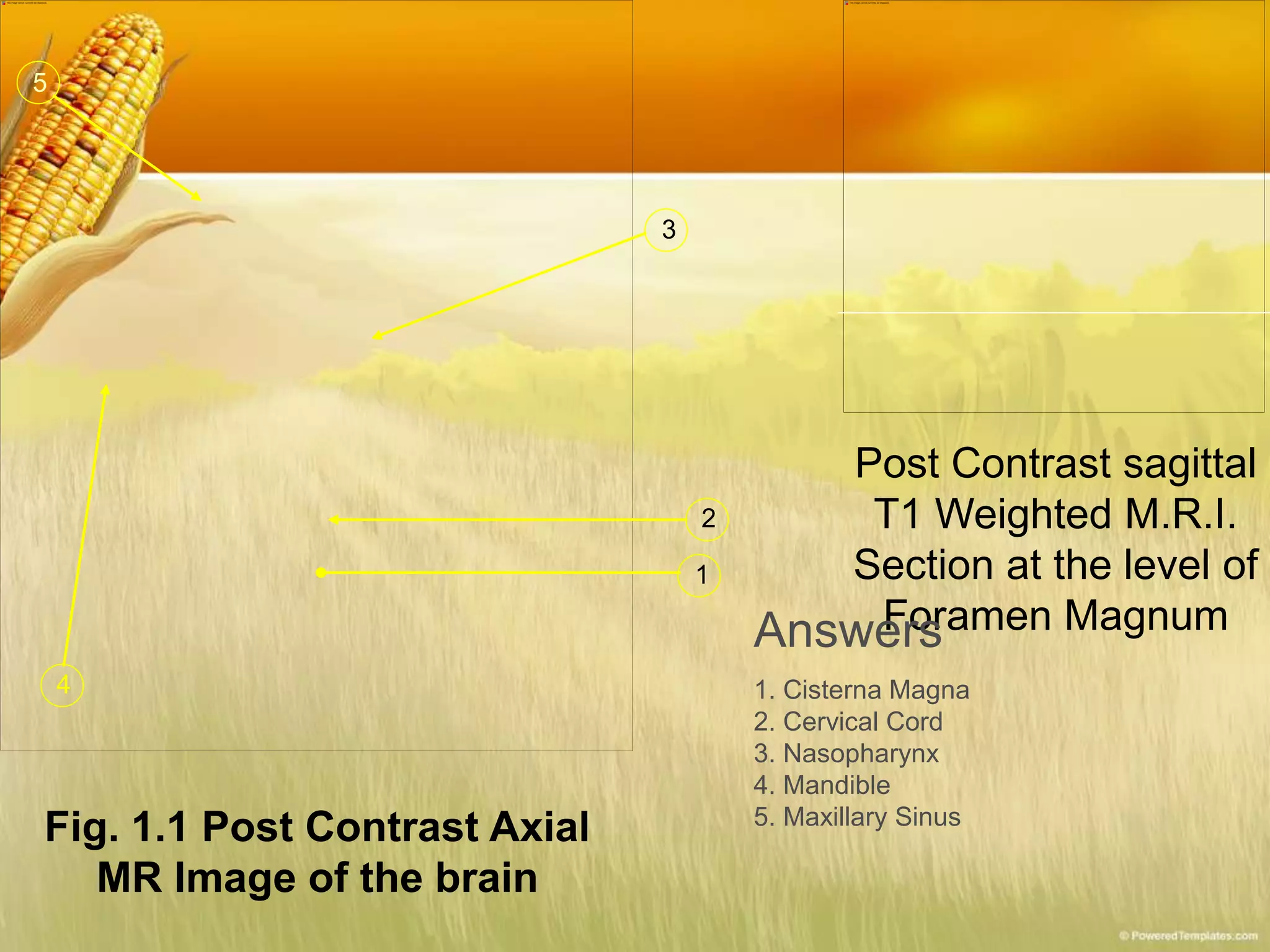 Fig. 1.1 Post Contrast Axial
MR Image of the brain
1
2
3
4
5
Post Contrast sagittal
T1 Weighted M.R.I.
Section at the level of
Foramen MagnumAnswers
1. Cisterna Magna
2. Cervical Cord
3. Nasopharynx
4. Mandible
5. Maxillary Sinus
 