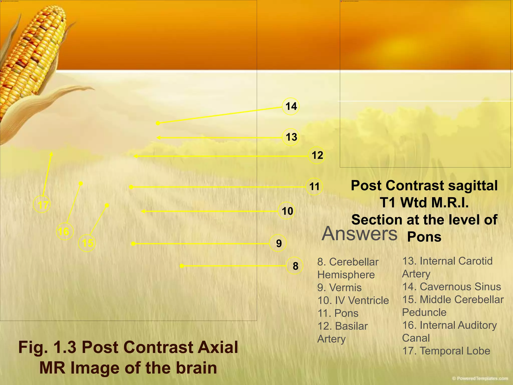 Fig. 1.3 Post Contrast Axial
MR Image of the brain
15
8
9
10
11
12
13
14
16
17
Post Contrast sagittal
T1 Wtd M.R.I.
Section at the level of
PonsAnswers
8. Cerebellar
Hemisphere
9. Vermis
10. IV Ventricle
11. Pons
12. Basilar
Artery
13. Internal Carotid
Artery
14. Cavernous Sinus
15. Middle Cerebellar
Peduncle
16. Internal Auditory
Canal
17. Temporal Lobe
 