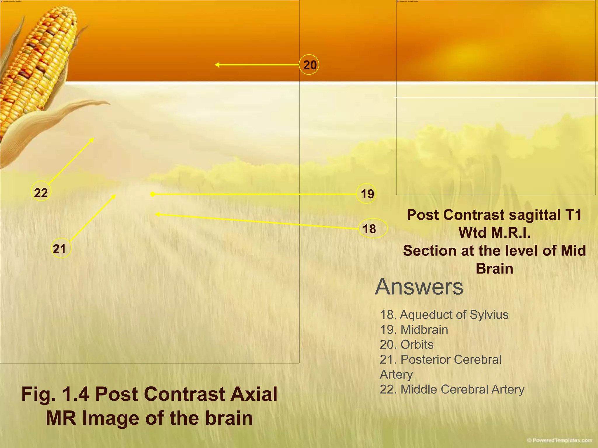 Fig. 1.4 Post Contrast Axial
MR Image of the brain
18
19
20
21
22
Post Contrast sagittal T1
Wtd M.R.I.
Section at the level of Mid
Brain
Answers
18. Aqueduct of Sylvius
19. Midbrain
20. Orbits
21. Posterior Cerebral
Artery
22. Middle Cerebral Artery
 
