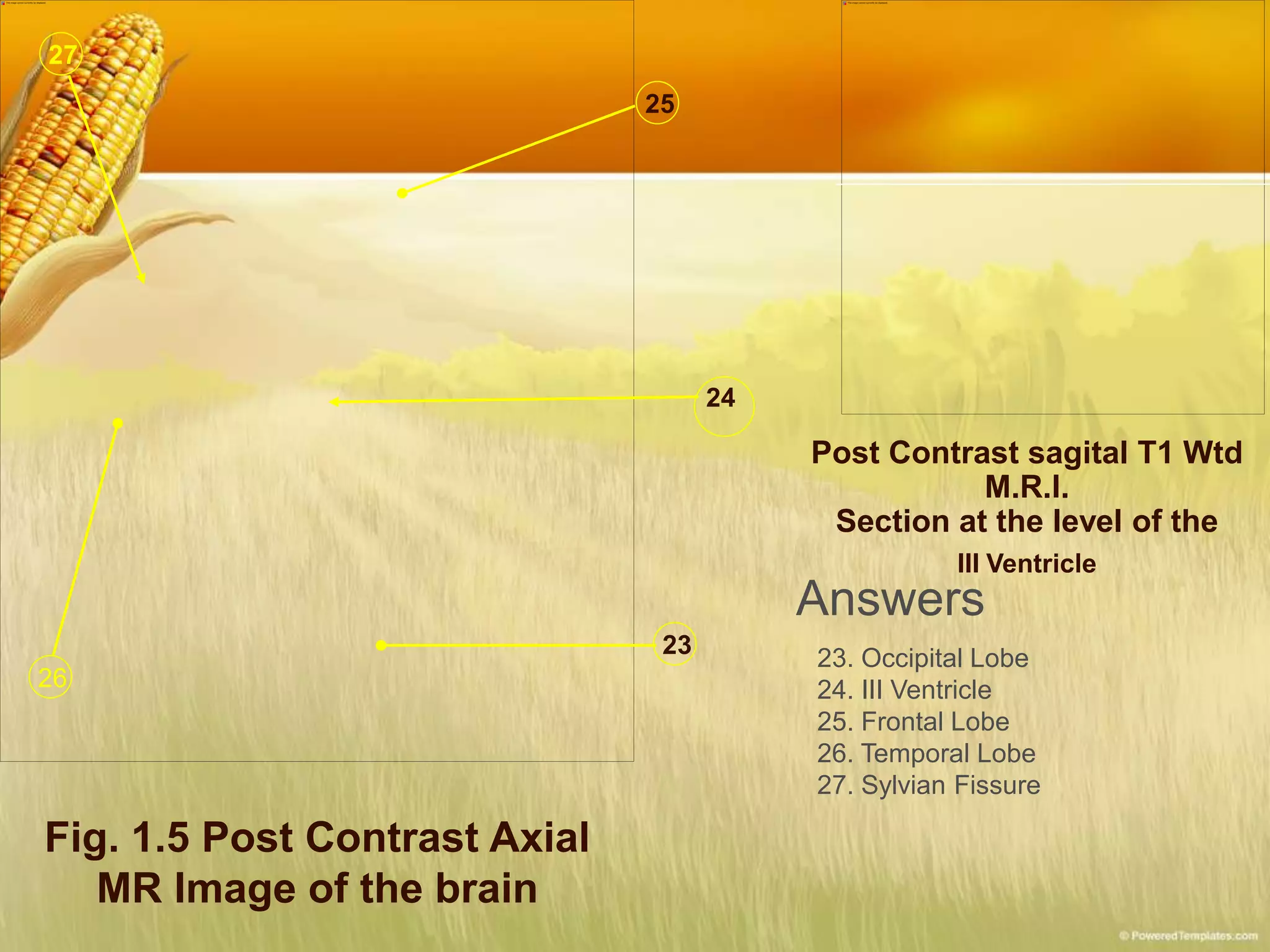 Fig. 1.5 Post Contrast Axial
MR Image of the brain
23
24
25
26
27
Post Contrast sagital T1 Wtd
M.R.I.
Section at the level of the
III Ventricle
Answers
23. Occipital Lobe
24. III Ventricle
25. Frontal Lobe
26. Temporal Lobe
27. Sylvian Fissure
 