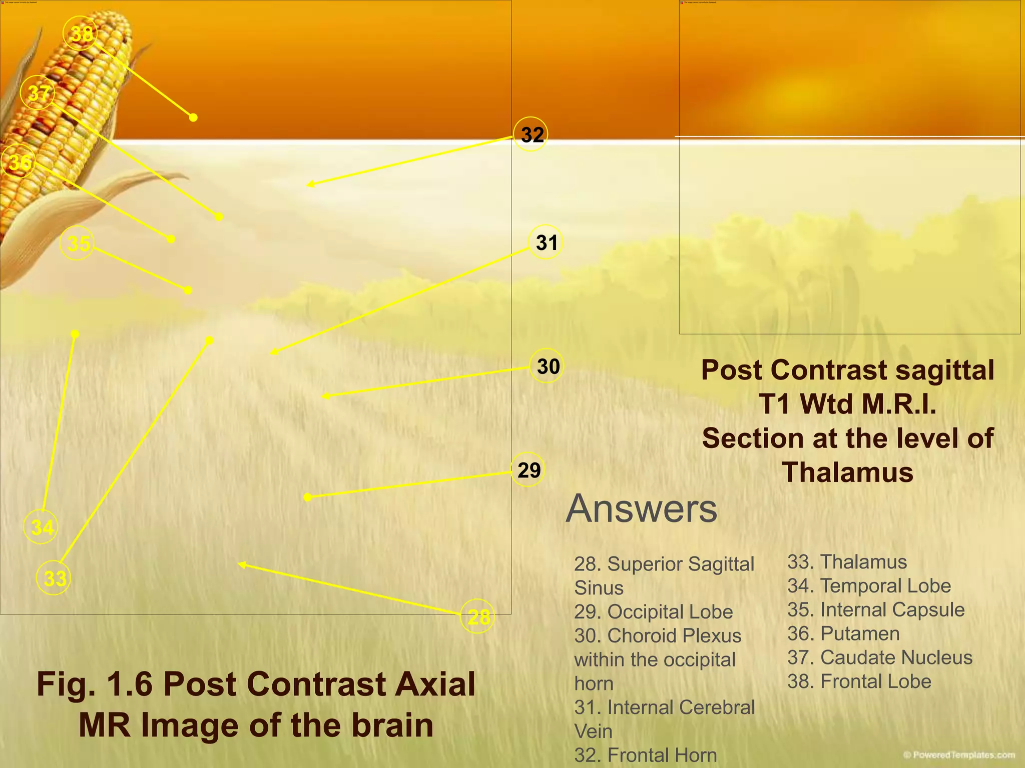 Fig. 1.6 Post Contrast Axial
MR Image of the brain
28
29
30
31
32
38
33
34
36
35
37
Post Contrast sagittal
T1 Wtd M.R.I.
Section at the level of
Thalamus
Answers
28. Superior Sagittal
Sinus
29. Occipital Lobe
30. Choroid Plexus
within the occipital
horn
31. Internal Cerebral
Vein
32. Frontal Horn
33. Thalamus
34. Temporal Lobe
35. Internal Capsule
36. Putamen
37. Caudate Nucleus
38. Frontal Lobe
 
