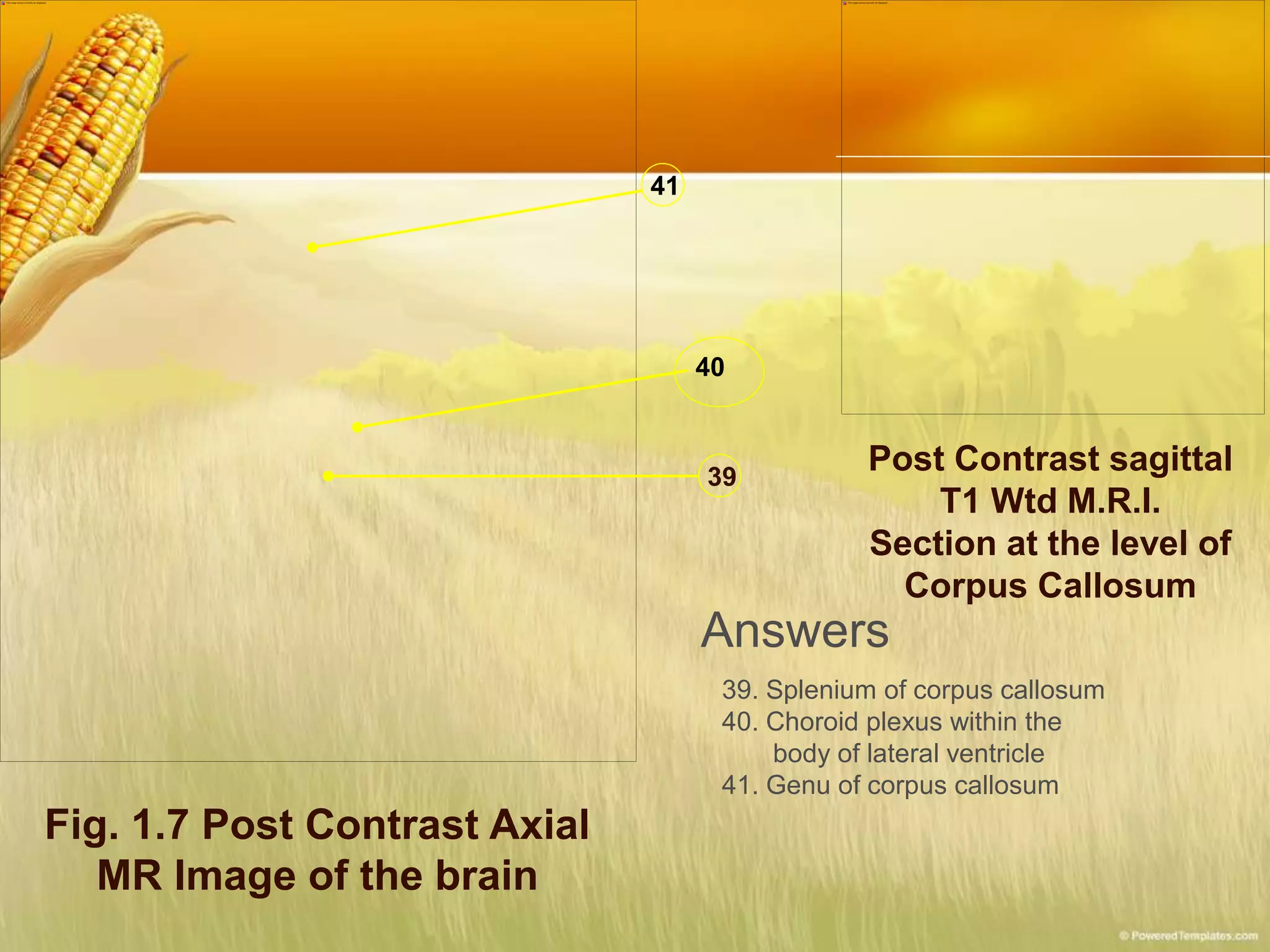 Fig. 1.7 Post Contrast Axial
MR Image of the brain
39
40
41
Post Contrast sagittal
T1 Wtd M.R.I.
Section at the level of
Corpus Callosum
Answers
39. Splenium of corpus callosum
40. Choroid plexus within the
body of lateral ventricle
41. Genu of corpus callosum
 