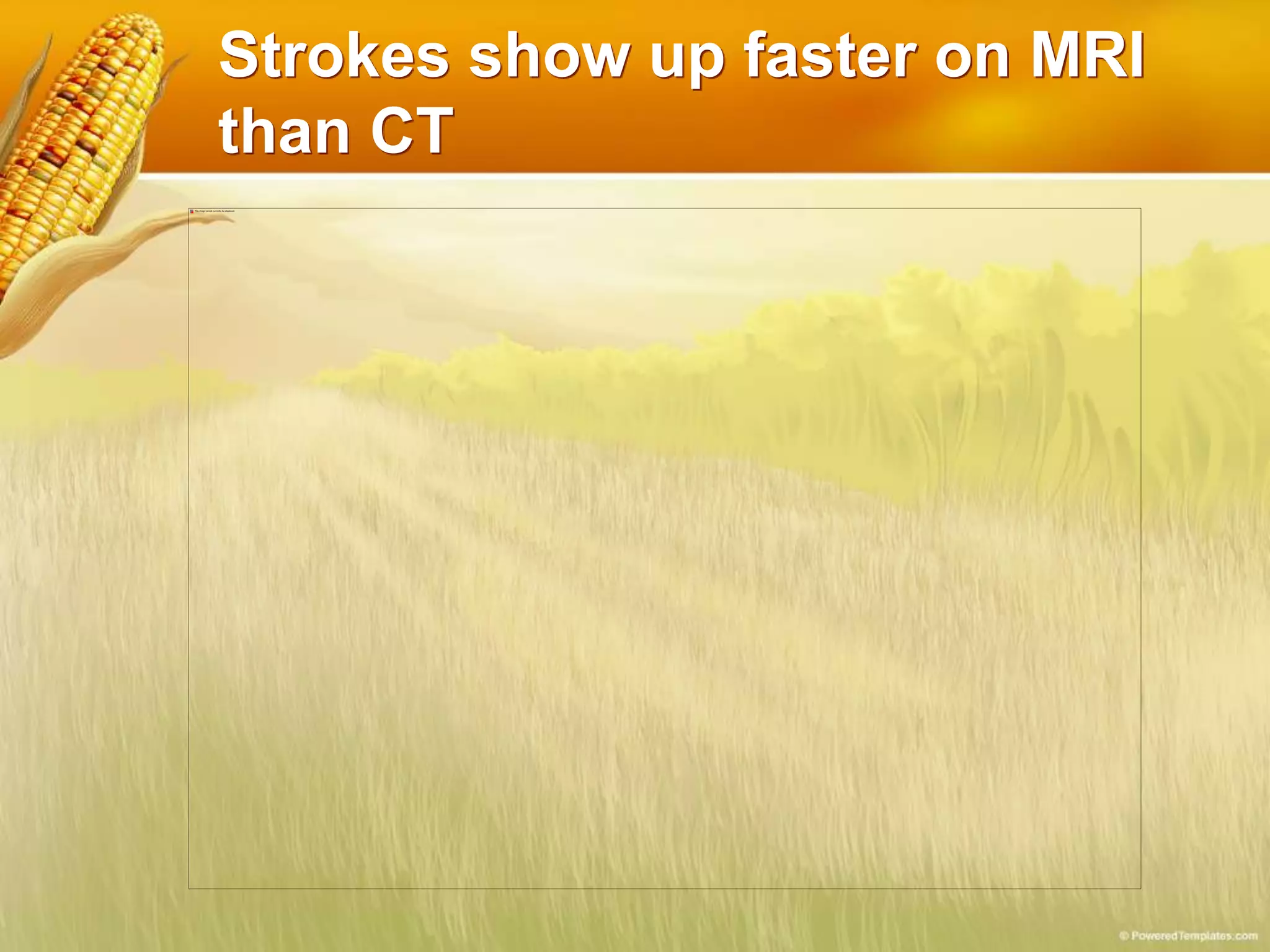 Strokes show up faster on MRI
than CT
 