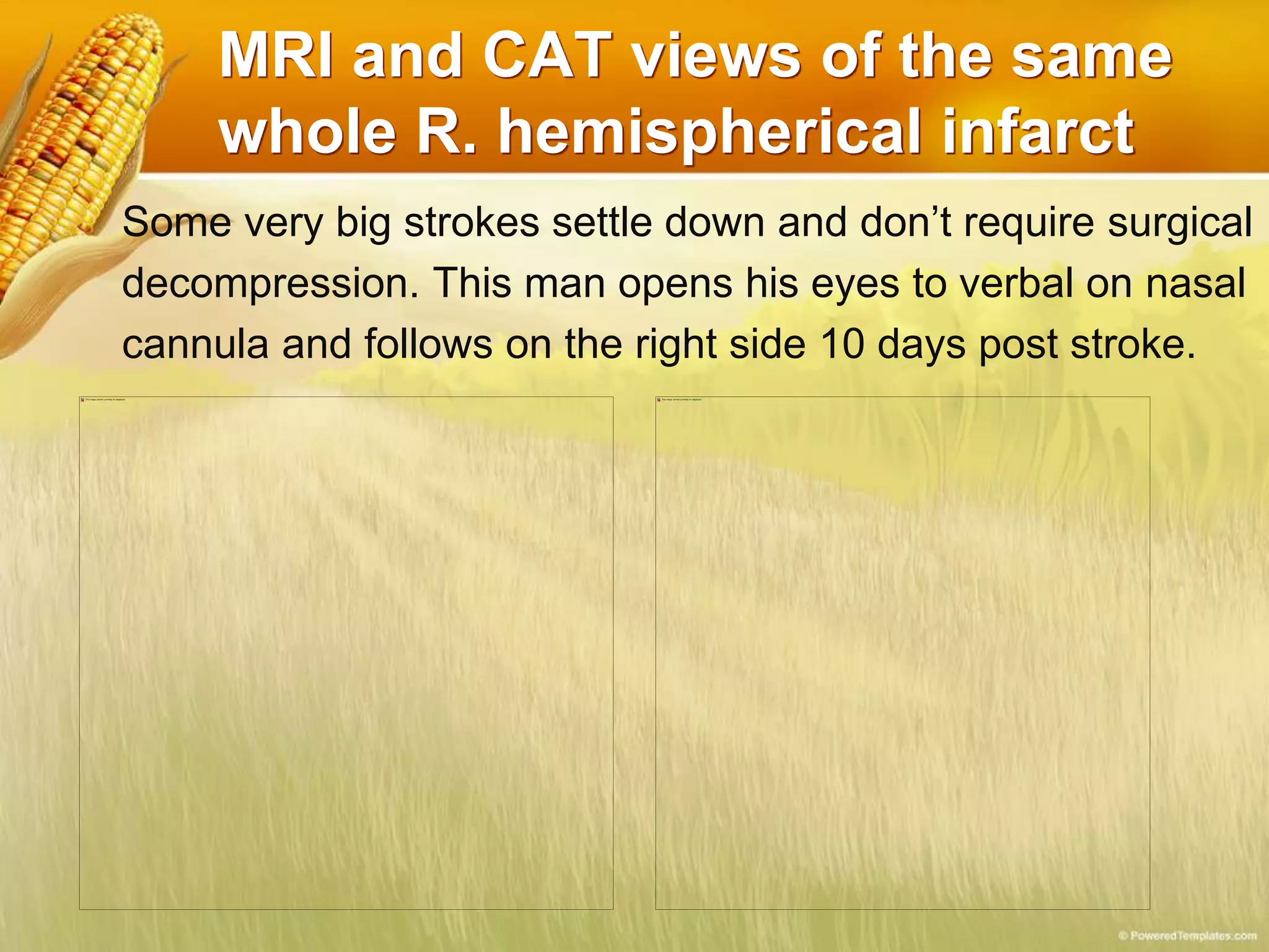 MRI and CAT views of the same
whole R. hemispherical infarct
Some very big strokes settle down and don’t require surgical
decompression. This man opens his eyes to verbal on nasal
cannula and follows on the right side 10 days post stroke.
 
