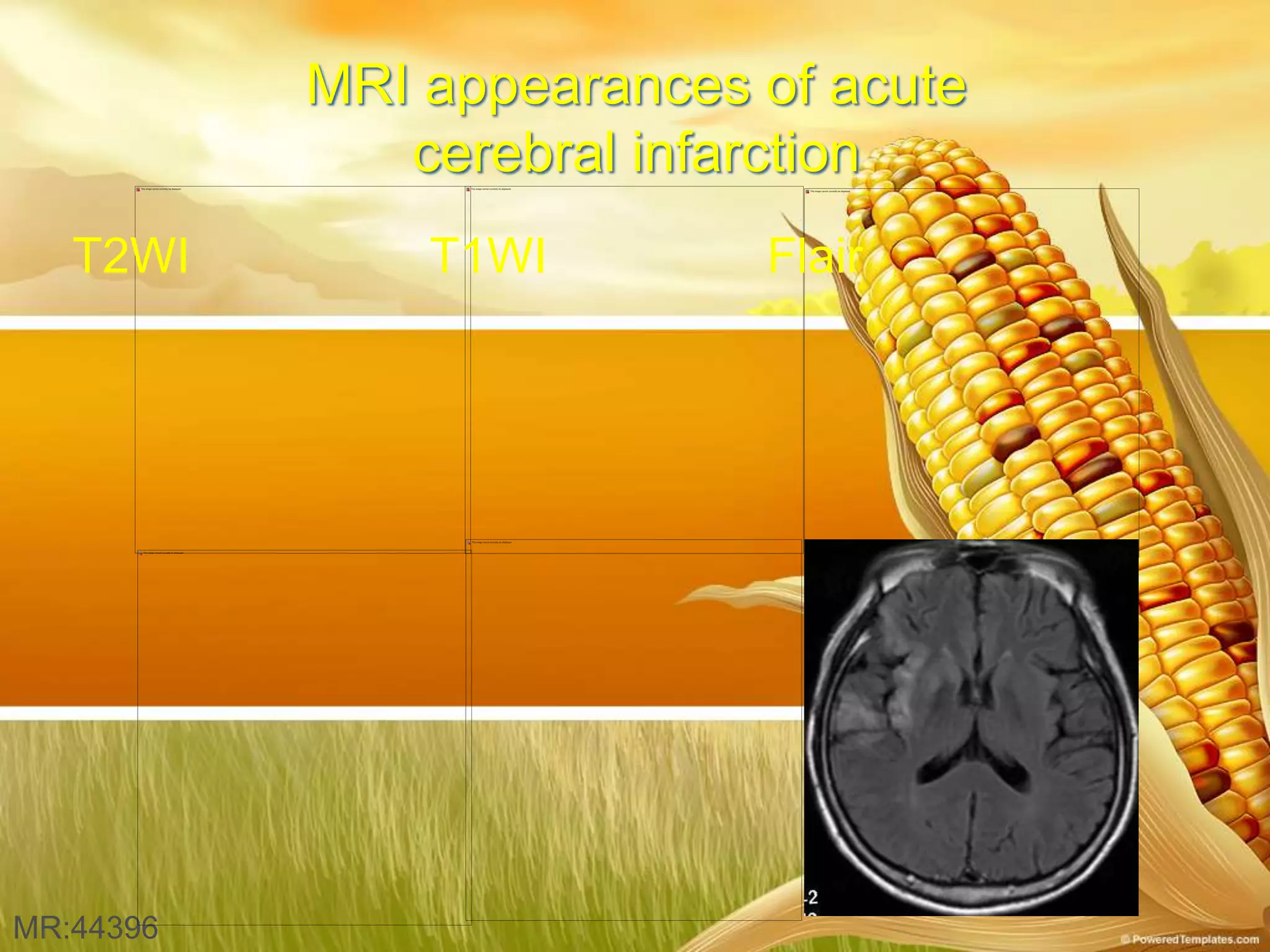 MR:44396
MRI appearances of acute
cerebral infarction
T2WI T1WI Flair
 