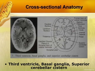 Cross-sectional Anatomy
• Third ventricle, Basal ganglia, Superior
cerebellar cistern
 
