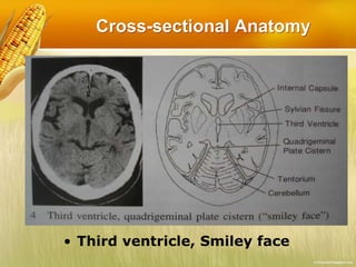 Cross-sectional Anatomy
• Third ventricle, Smiley face
 