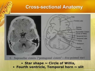 Cross-sectional Anatomy
• Star shape ~ Circle of Willis,
• Fourth ventricle, Temporal horn ~ slit
 
