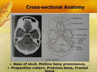 Cross-sectional Anatomy
• Base of skull, Midline bony prominence,
• Prepontine cistern, Pretrous bone, Frontal
 
