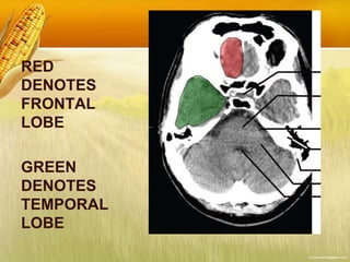 RED
DENOTES
FRONTAL
LOBE
GREEN
DENOTES
TEMPORAL
LOBE
 