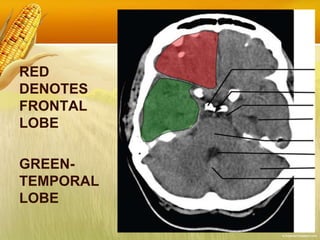 RED
DENOTES
FRONTAL
LOBE
GREEN-
TEMPORAL
LOBE
 