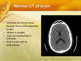 Normal CT of brain
• Ventricles are normal sized,
the grey versus white distinction
is clear.
• Midline is straight.
• Sulci are symmetrical on
bothsides.
• Skull is intact with no
scalp edema.
 