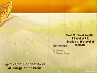 Fig. 1.2 Post Contrast Axial
MR Image of the brain
7
6
Post Contrast sagittal
T1 Wtd M.R.I.
Section at the level of
medulla
Answers
6. Medulla
7. Sigmoid Sinus
 