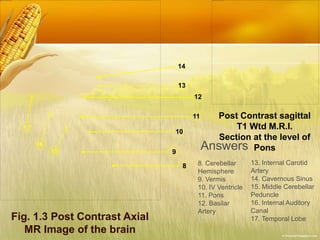 Fig. 1.3 Post Contrast Axial
MR Image of the brain
15
8
9
10
11
12
13
14
16
17
Post Contrast sagittal
T1 Wtd M.R.I.
Section at the level of
PonsAnswers
8. Cerebellar
Hemisphere
9. Vermis
10. IV Ventricle
11. Pons
12. Basilar
Artery
13. Internal Carotid
Artery
14. Cavernous Sinus
15. Middle Cerebellar
Peduncle
16. Internal Auditory
Canal
17. Temporal Lobe
 