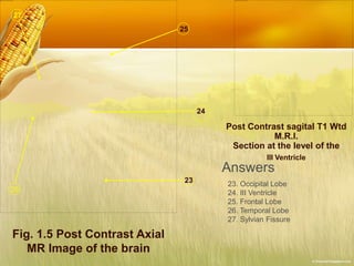 Fig. 1.5 Post Contrast Axial
MR Image of the brain
23
24
25
26
27
Post Contrast sagital T1 Wtd
M.R.I.
Section at the level of the
III Ventricle
Answers
23. Occipital Lobe
24. III Ventricle
25. Frontal Lobe
26. Temporal Lobe
27. Sylvian Fissure
 