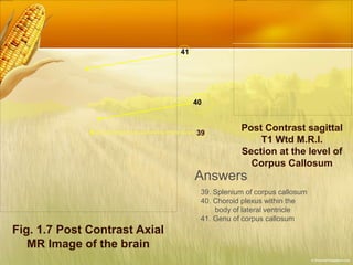 Fig. 1.7 Post Contrast Axial
MR Image of the brain
39
40
41
Post Contrast sagittal
T1 Wtd M.R.I.
Section at the level of
Corpus Callosum
Answers
39. Splenium of corpus callosum
40. Choroid plexus within the
body of lateral ventricle
41. Genu of corpus callosum
 