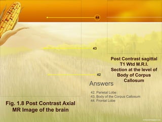 Fig. 1.8 Post Contrast Axial
MR Image of the brain
42
43
44
Post Contrast sagittal
T1 Wtd M.R.I.
Section at the level of
Body of Corpus
Callosum
Answers
42. Parietal Lobe
43. Body of the Corpus Callosum
44. Frontal Lobe
 