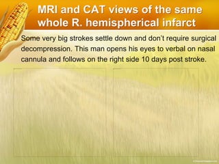 MRI and CAT views of the same
whole R. hemispherical infarct
Some very big strokes settle down and don’t require surgical
decompression. This man opens his eyes to verbal on nasal
cannula and follows on the right side 10 days post stroke.
 