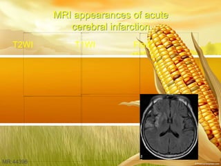 MR:44396
MRI appearances of acute
cerebral infarction
T2WI T1WI Flair
 