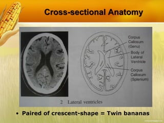 Cross-sectional Anatomy
• Paired of crescent-shape = Twin bananas
 
