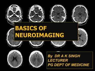 By DR A K SINGH
LECTURER
PG DEPT OF MEDICINE
BASICS OF
NEUROIMAGING
 