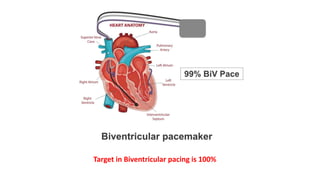 Basics of Pacemaker Dr Hafeesh Fazulu Pushpagiri | PPTX