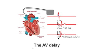 Basics of Pacemaker Dr Hafeesh Fazulu Pushpagiri | PPTX