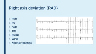 Rad Ecg Example Basics of Paediatric ECG | PPTX