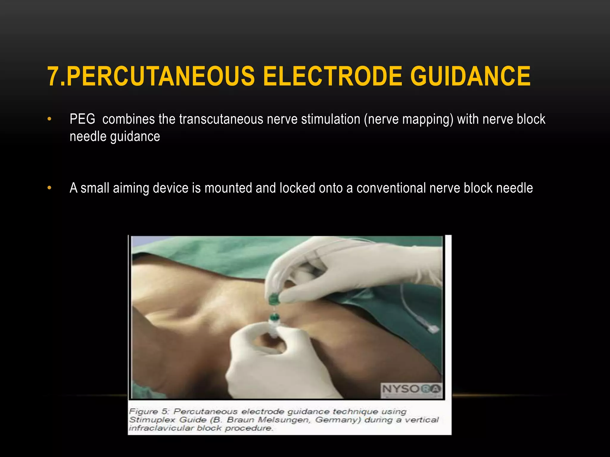 • PEG combines the transcutaneous nerve stimulation (nerve mapping) with nerve block
needle guidance
• A small aiming device is mounted and locked onto a conventional nerve block needle
7.PERCUTANEOUS ELECTRODE GUIDANCE
 